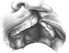 cleft-B%20(11).gif