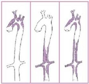    takayasu arteritis   