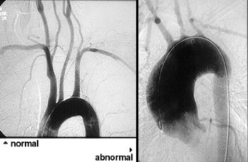    takayasu arteritis   