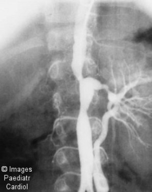    takayasu arteritis   