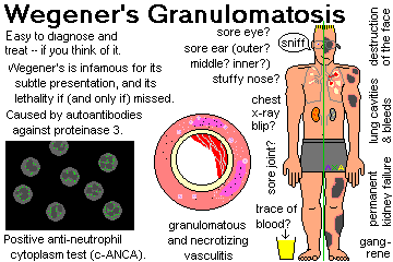   Wegeners granulomatosis 