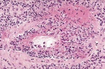   Wegeners granulomatosis 